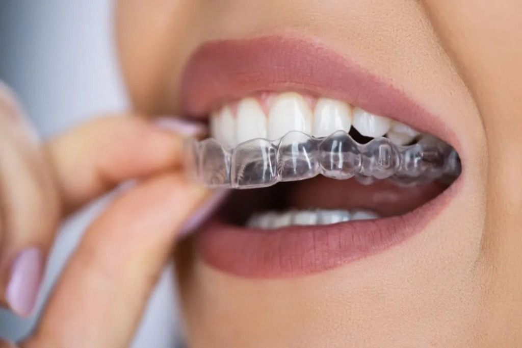 Invisible Aligners Treatment